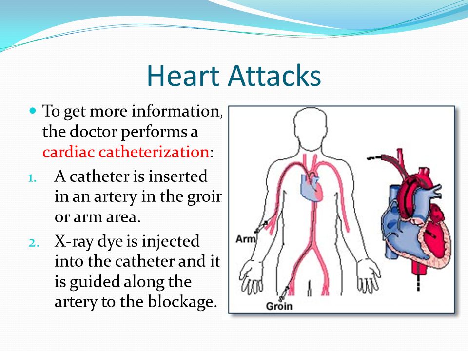 Heart Attacks To get more information, the doctor performs a cardiac catheterization: 1.