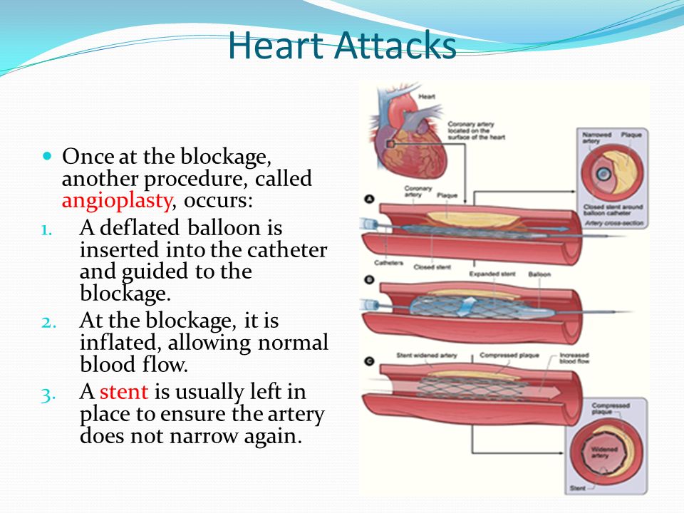 Heart Attacks Once at the blockage, another procedure, called angioplasty, occurs: 1.