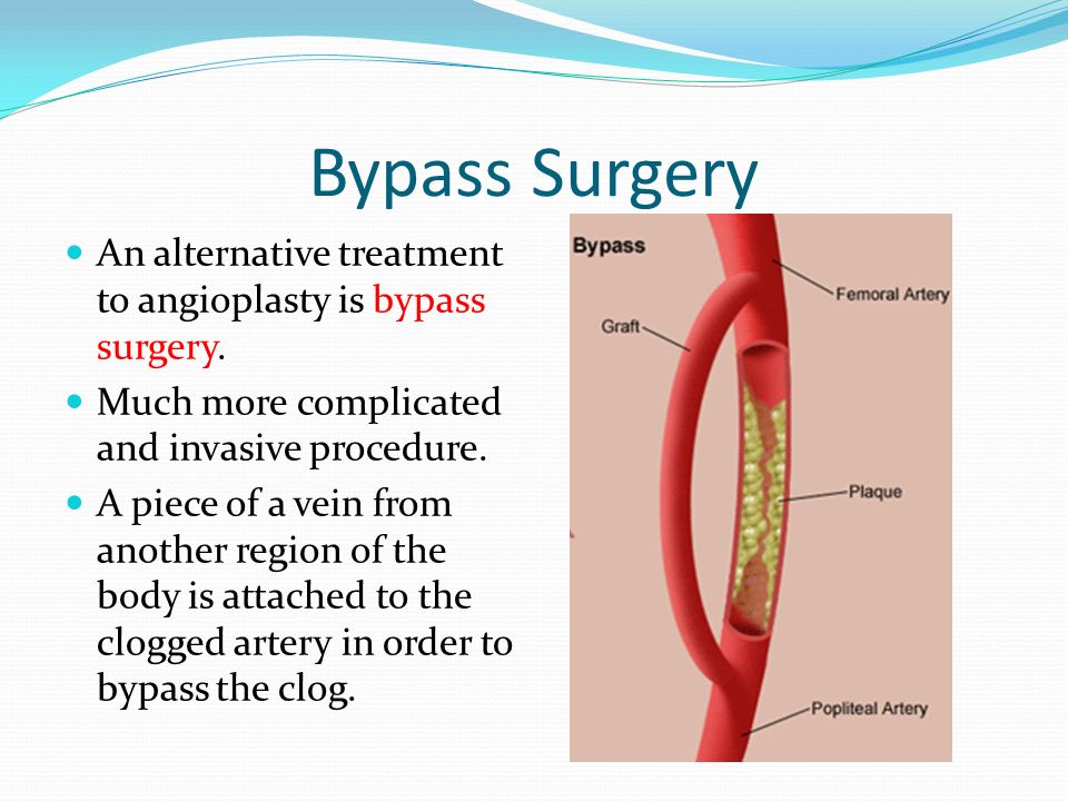 Bypass Surgery An alternative treatment to angioplasty is bypass surgery.