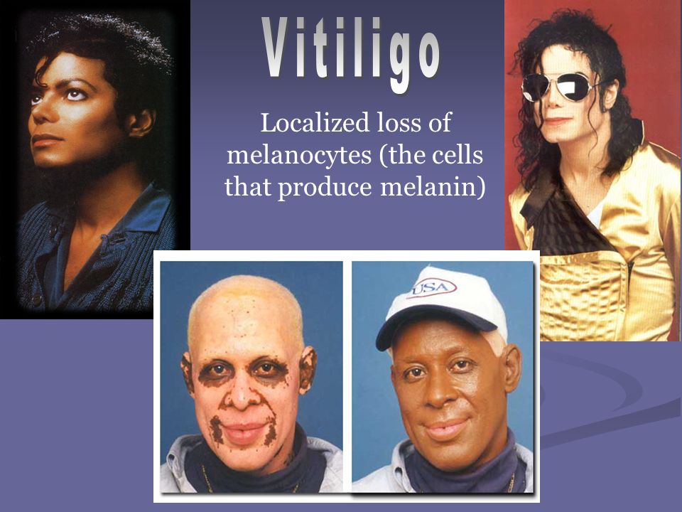 Localized loss of melanocytes (the cells that produce melanin)