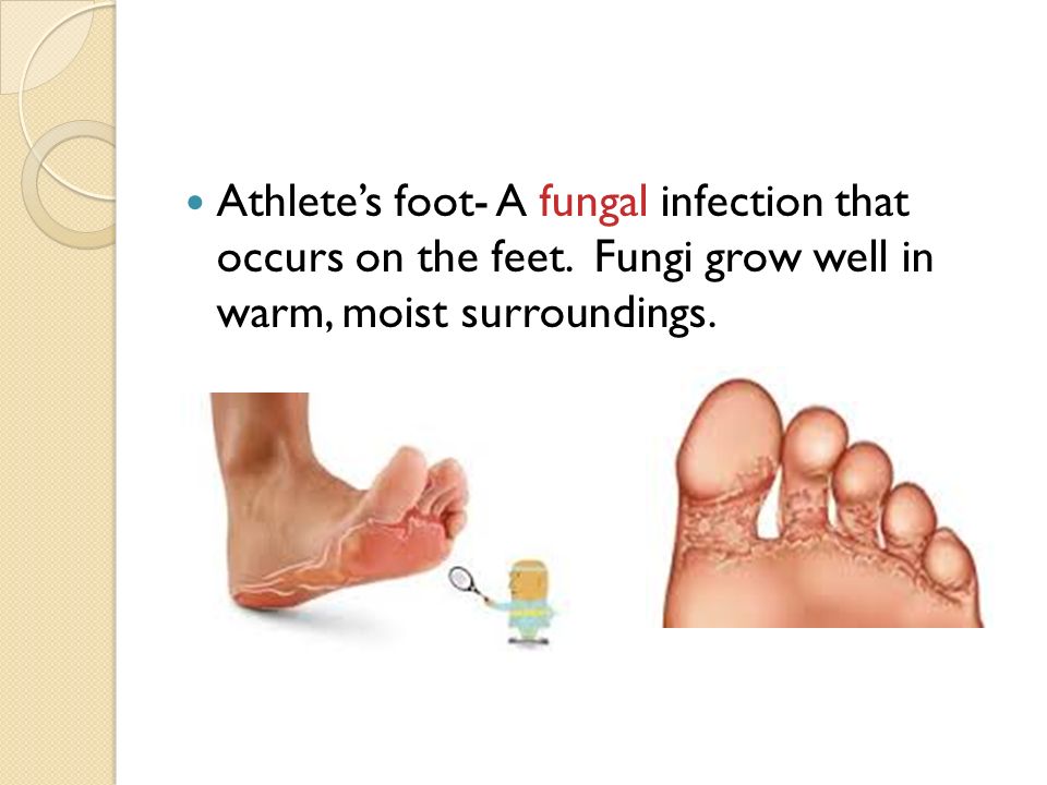 Athlete’s foot- A fungal infection that occurs on the feet.