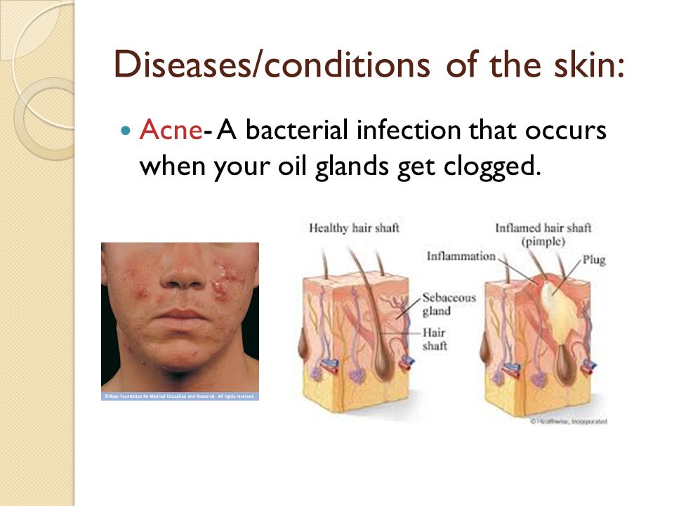 Diseases/conditions of the skin: Acne- A bacterial infection that occurs when your oil glands get clogged.