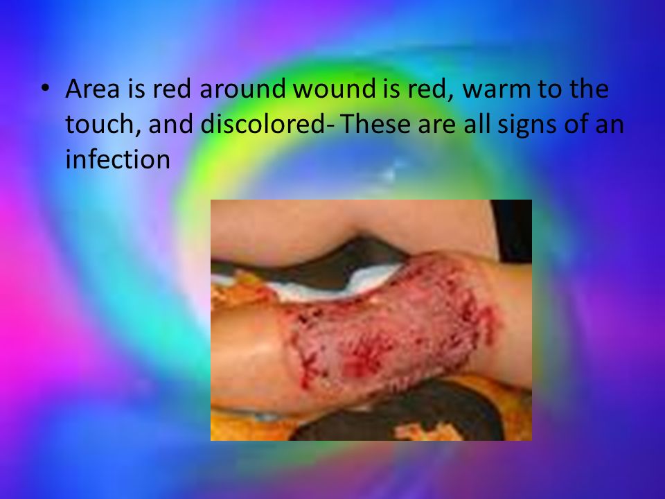 Area is red around wound is red, warm to the touch, and discolored- These are all signs of an infection
