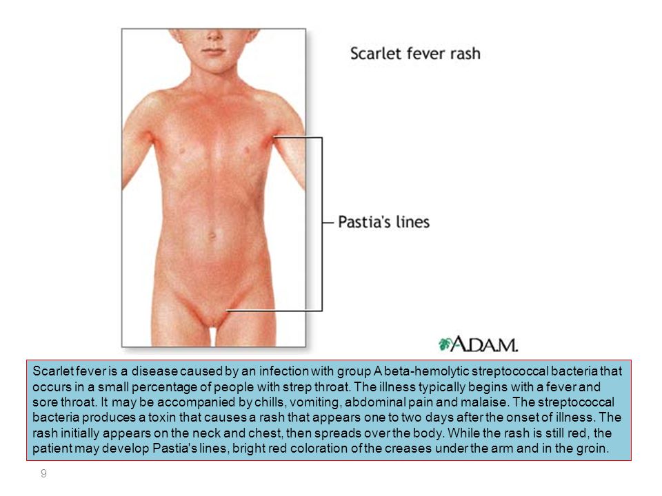 Bacterium strep throat
