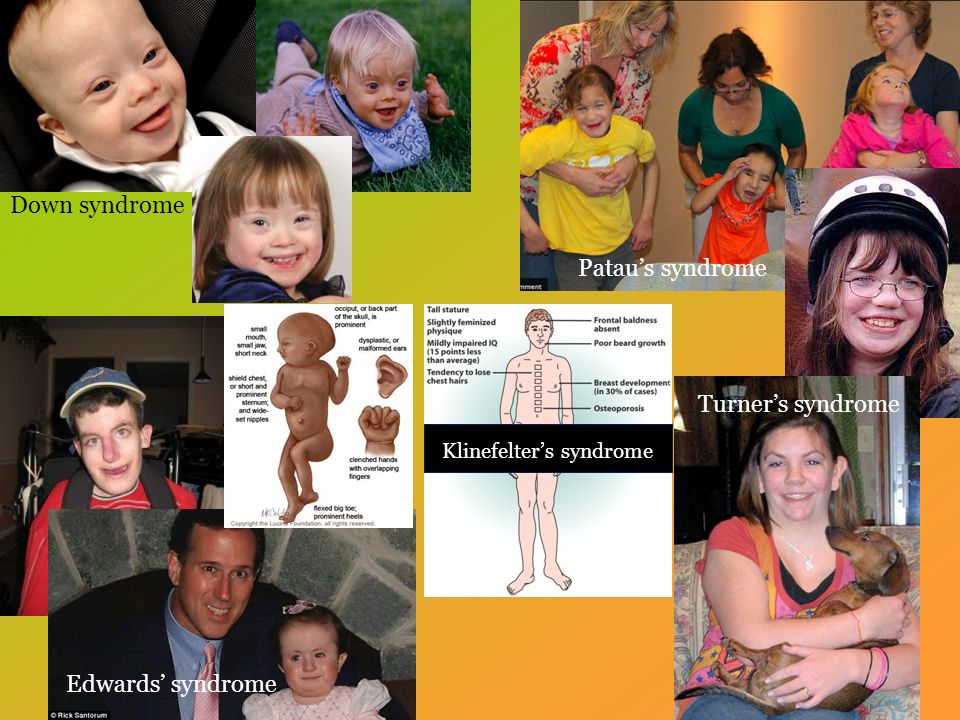 Down syndrome Turner’s syndrome Patau’s syndrome Edwards’ syndrome Klinefelter’s syndrome