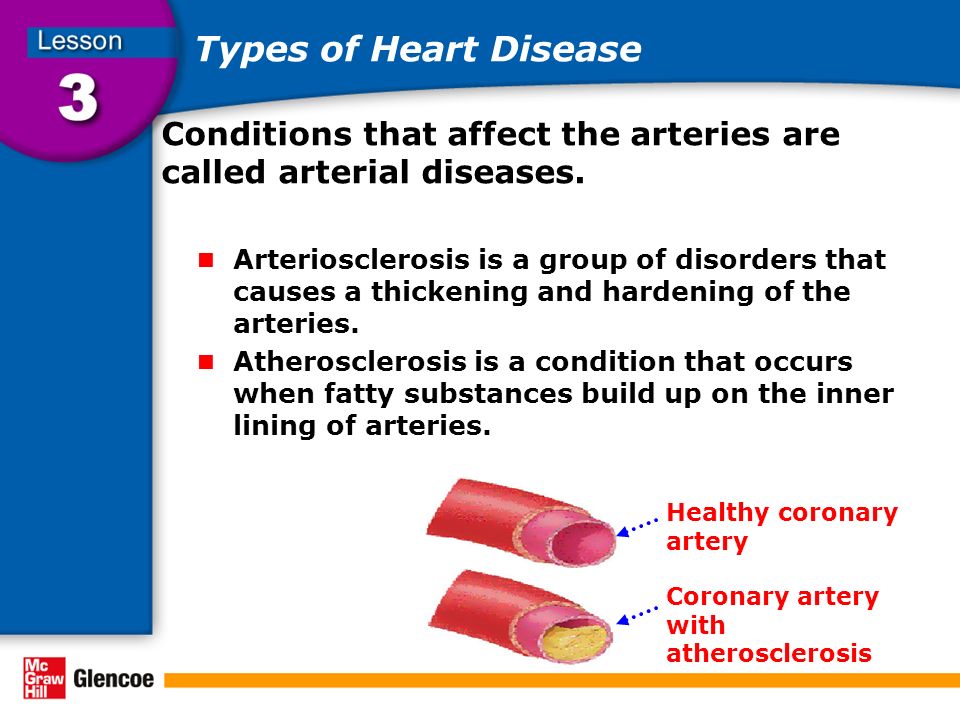 Types of Heart Disease Conditions that affect the arteries are called arterial diseases.