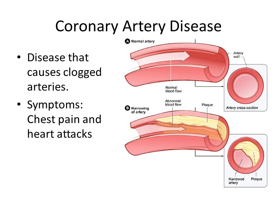 Coronary Artery Disease Disease that causes clogged arteries.