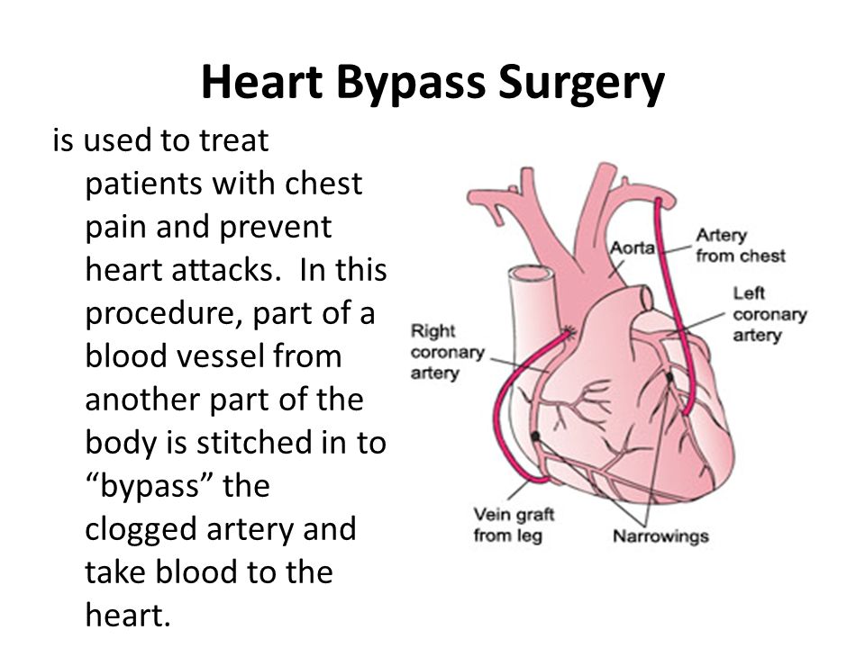 Heart Bypass Surgery is used to treat patients with chest pain and prevent heart attacks.