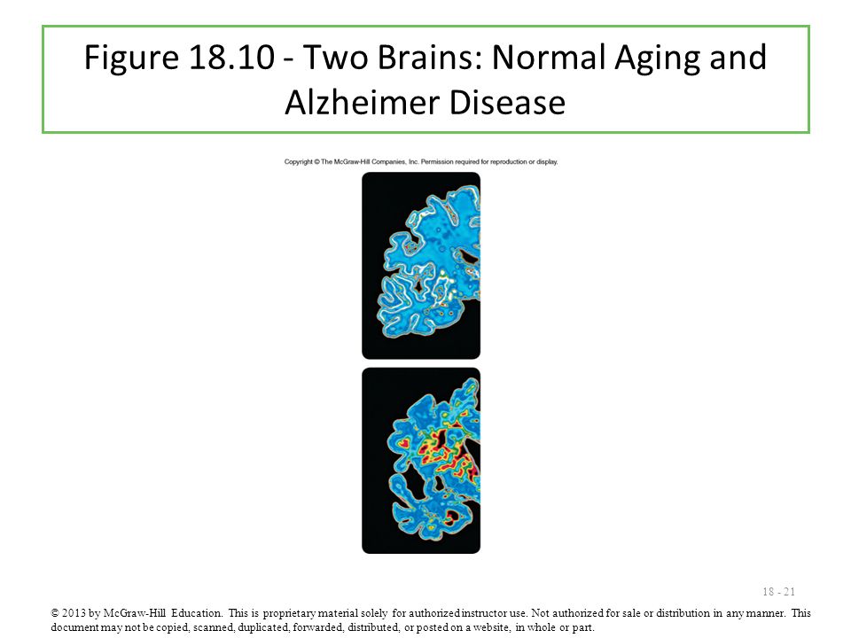 Figure Two Brains: Normal Aging and Alzheimer Disease © 2013 by McGraw-Hill Education.