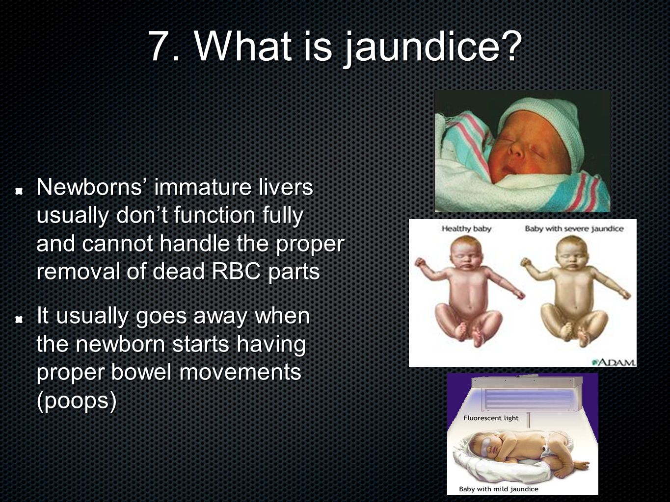 7. What is jaundice.