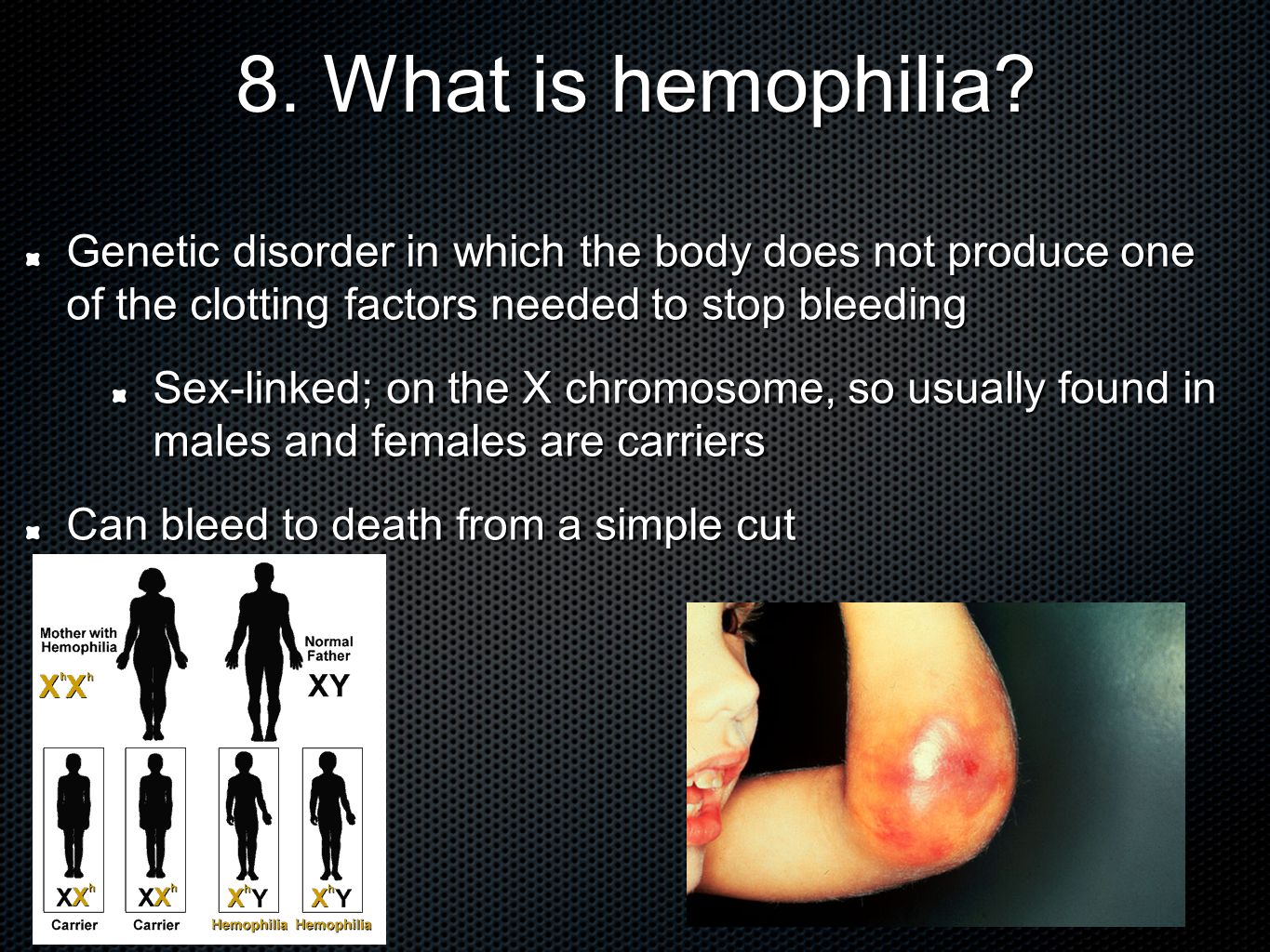 8. What is hemophilia.