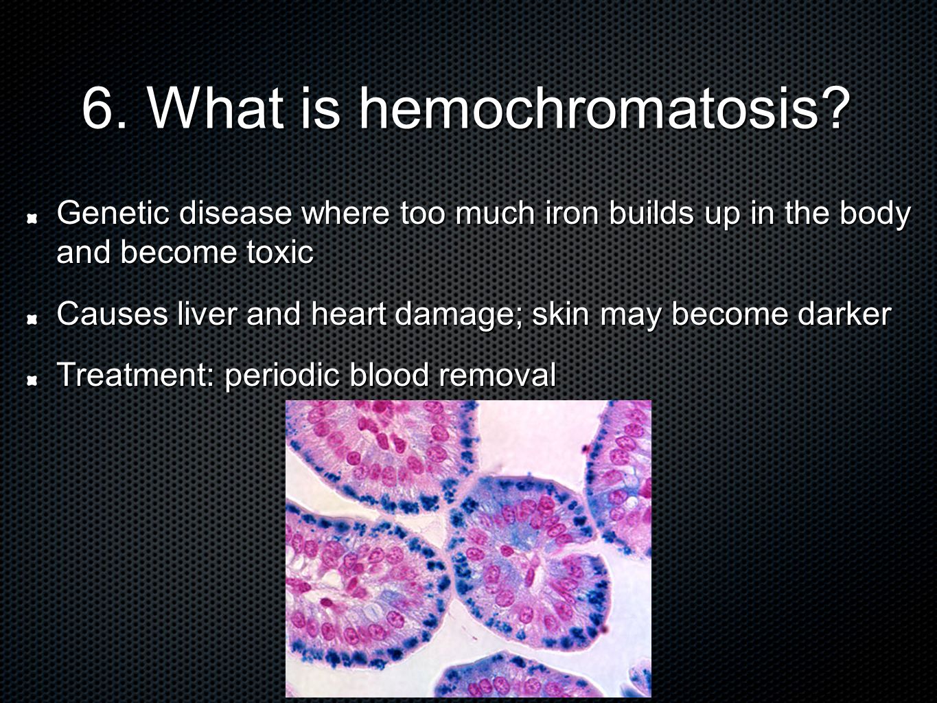 6. What is hemochromatosis.