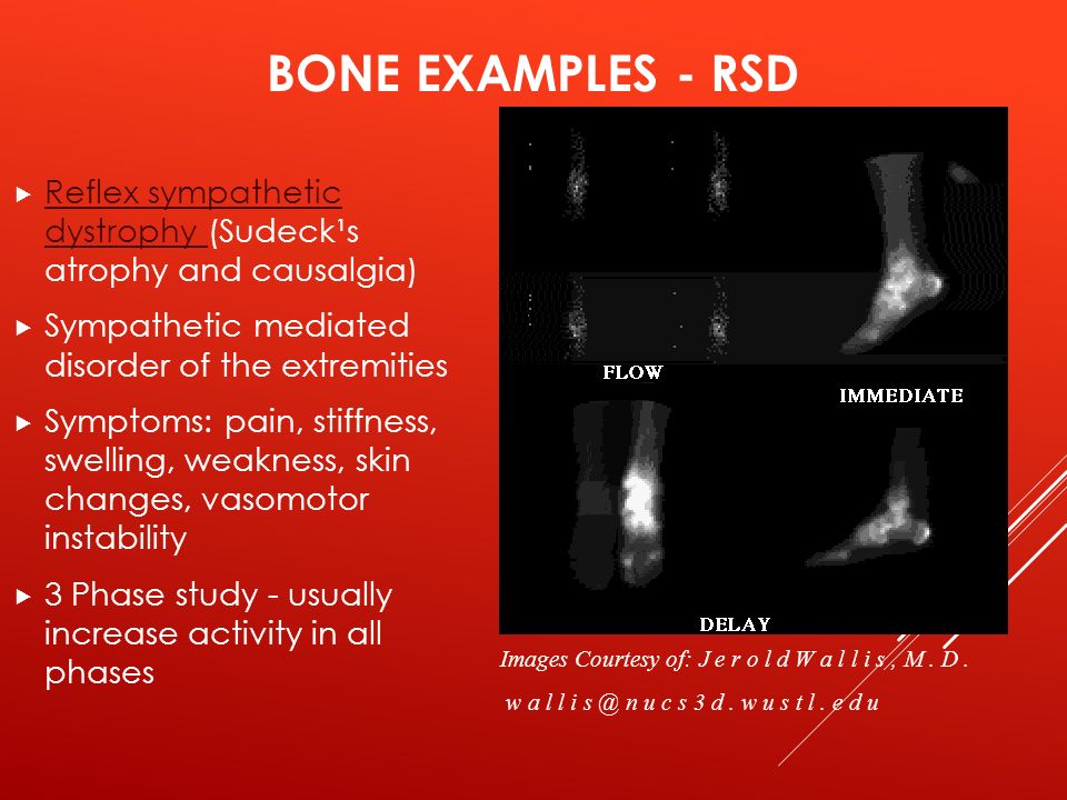 Reflex Sympathetic Dystrophy Levitra