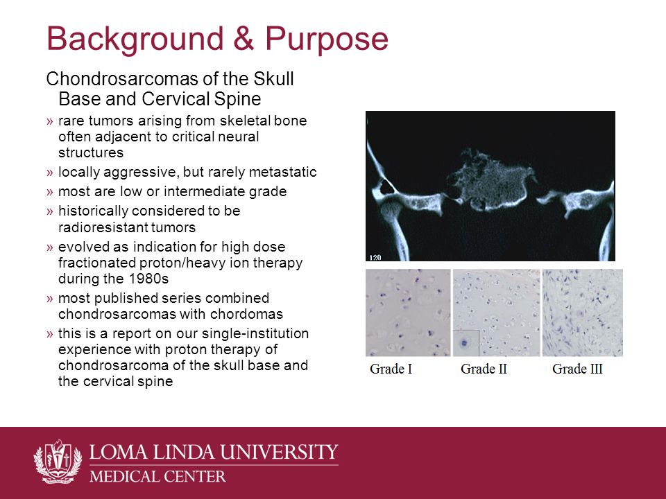 Background & Purpose Chondrosarcomas of the Skull Base and Cervical Spine »rare tumors arising from skeletal bone often adjacent to critical neural structures »locally aggressive, but rarely metastatic »most are low or intermediate grade »historically considered to be radioresistant tumors »evolved as indication for high dose fractionated proton/heavy ion therapy during the 1980s »most published series combined chondrosarcomas with chordomas »this is a report on our single-institution experience with proton therapy of chondrosarcoma of the skull base and the cervical spine