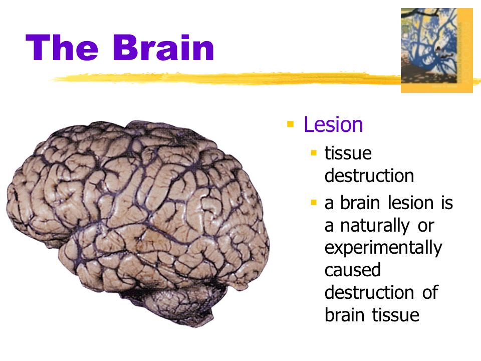  Lesion  tissue destruction  a brain lesion is a naturally or experimentally caused destruction of brain tissue