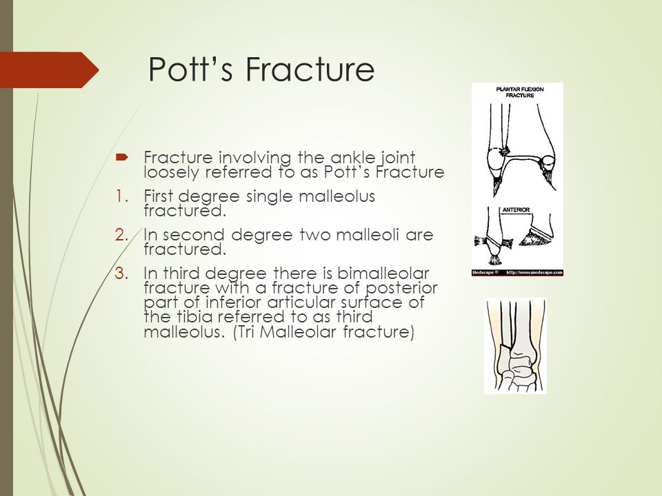 pott s fracture