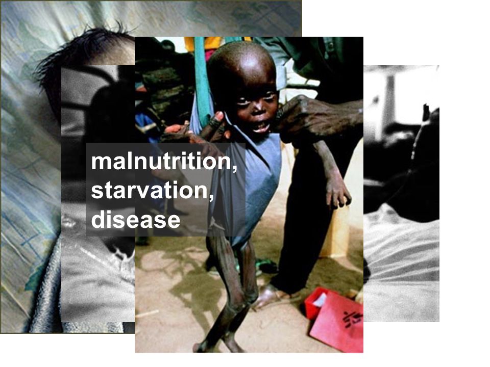 malnutrition, starvation, disease