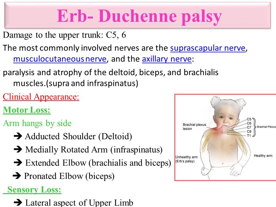 erb duchenne palsy rome fontanacountryinn com erb duchenne