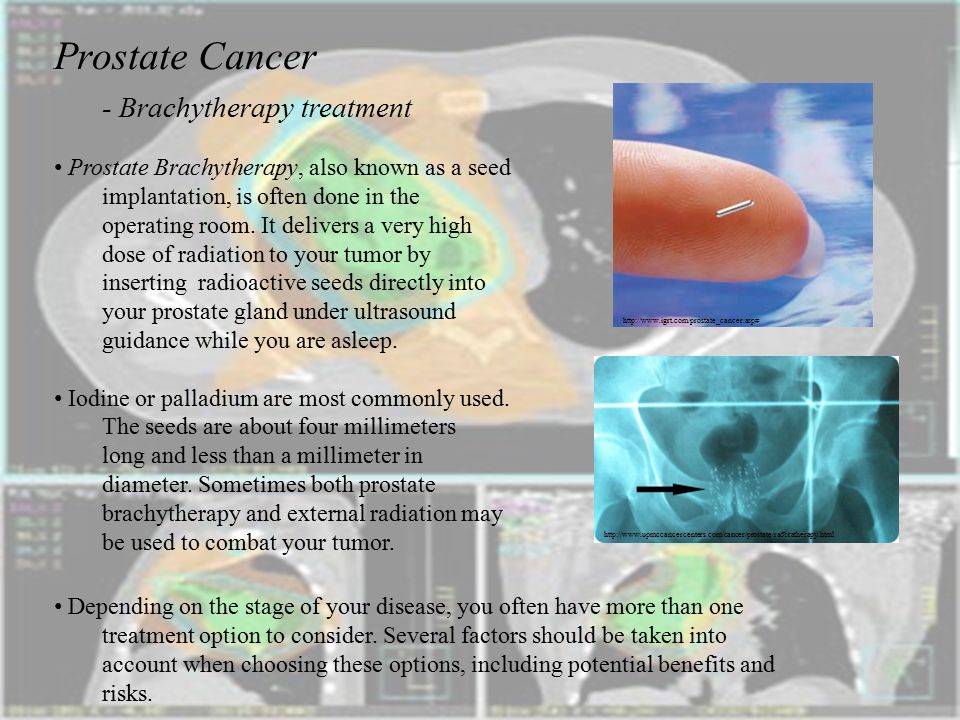 Prostate Cancer Brachytherapy Cialis Daily