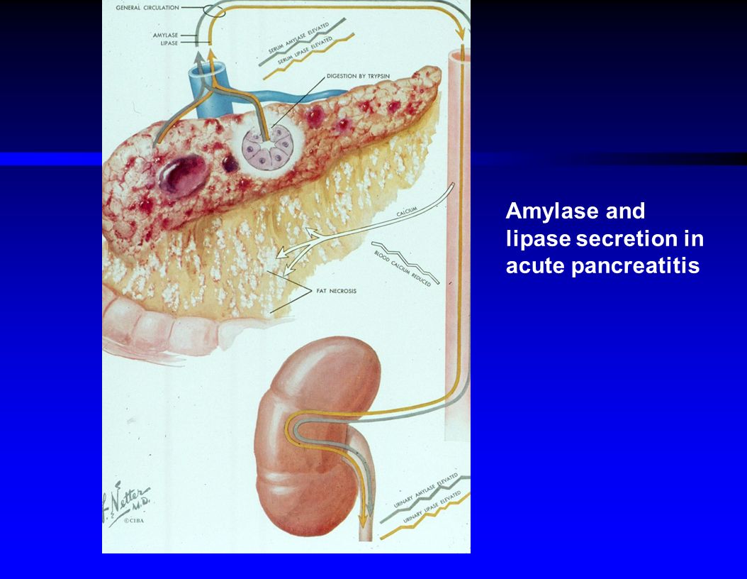 acute pancreatitis nhg