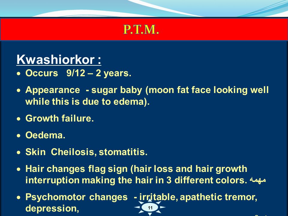 Childhood Nutritional Disorders Dr Abdullah Al Sanie Consultant 12 Kwashiorkor Occurs