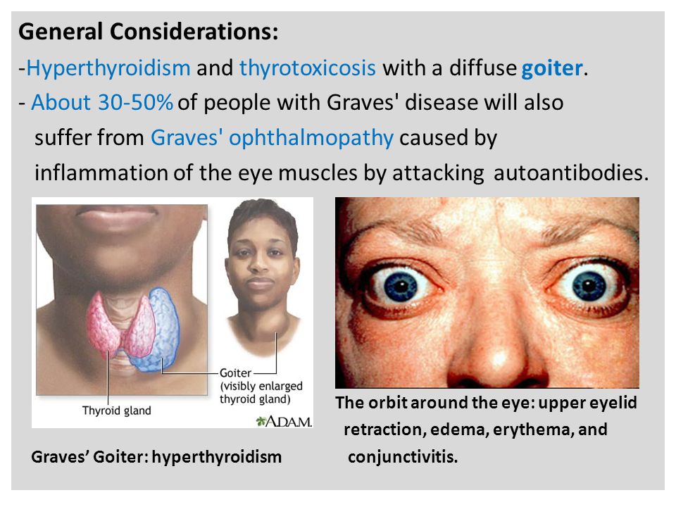n General Considerations: -Hyperthyroidism and thyrotoxicosis with a diffuse goiter.
