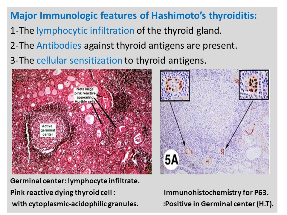 N Major Immunologic features of Hashimoto’s thyroiditis: 1-The lymphocytic infiltration of the thyroid gland.