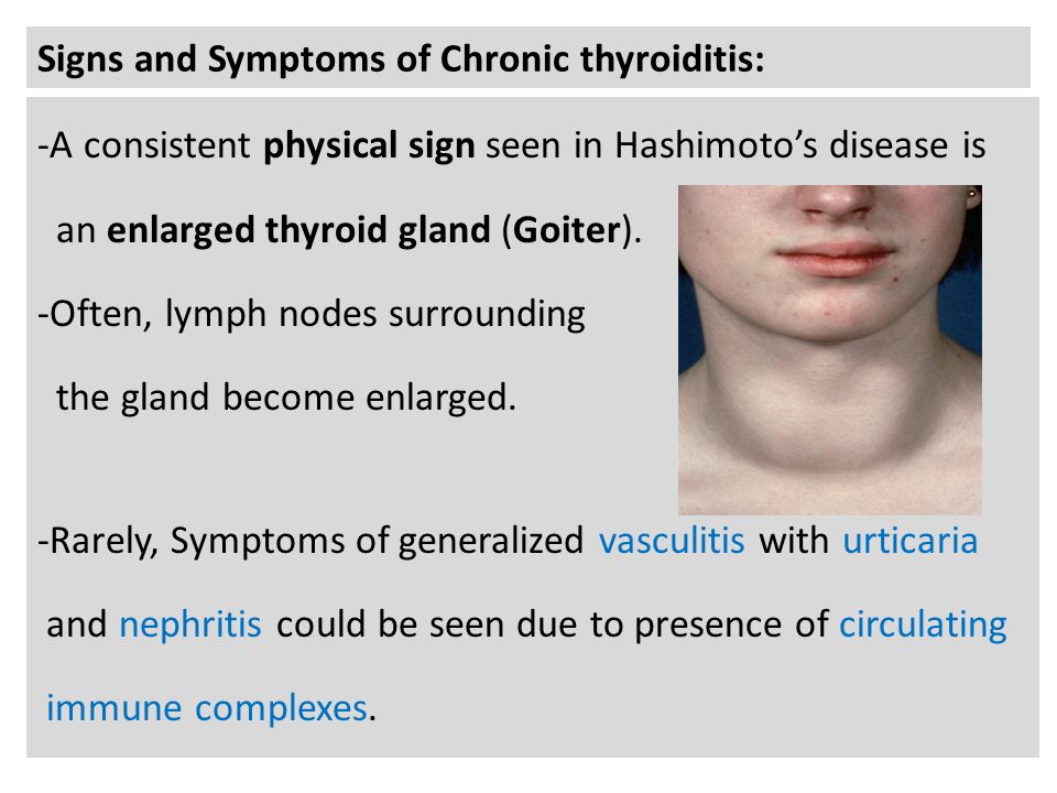 Signs and Symptoms of Chronic thyroiditis: -A consistent physical sign seen in Hashimoto’s disease is an enlarged thyroid gland (Goiter).