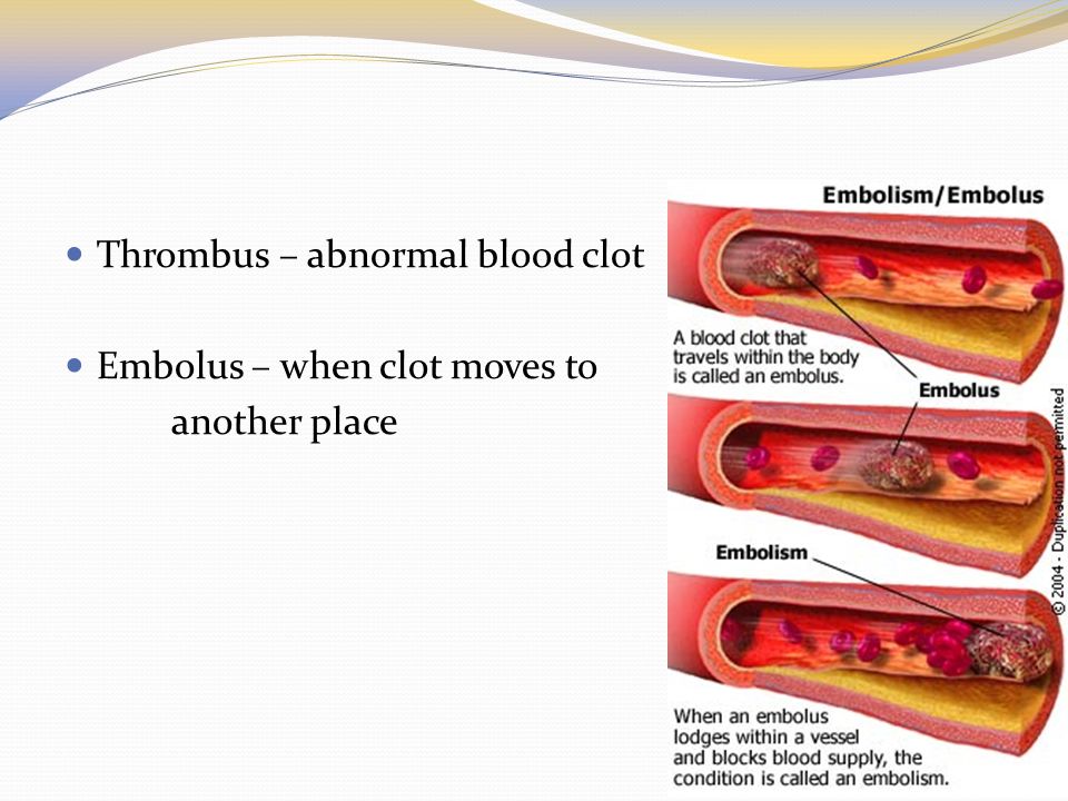 Thrombus – abnormal blood clot Embolus – when clot moves to another place