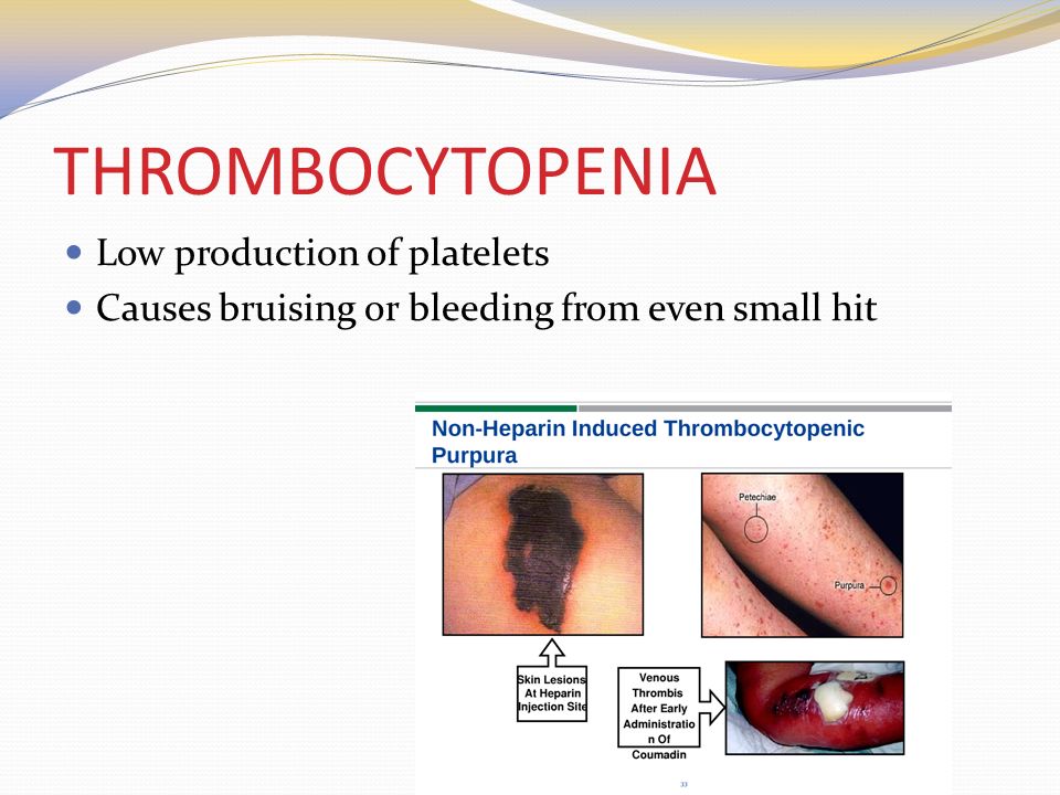 THROMBOCYTOPENIA Low production of platelets Causes bruising or bleeding from even small hit
