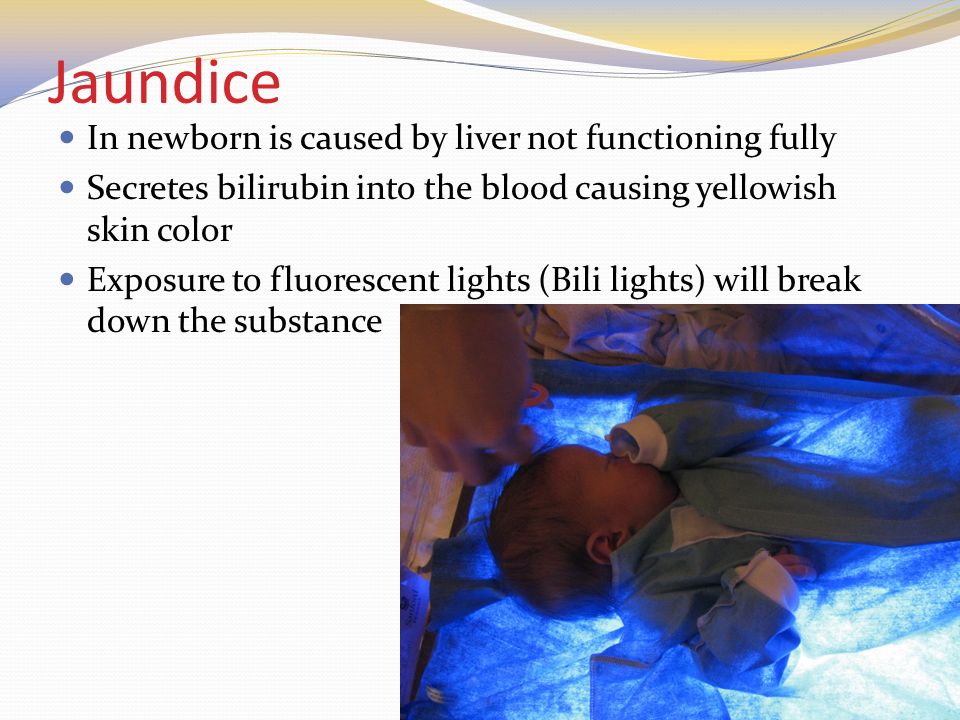 Jaundice In newborn is caused by liver not functioning fully Secretes bilirubin into the blood causing yellowish skin color Exposure to fluorescent lights (Bili lights) will break down the substance