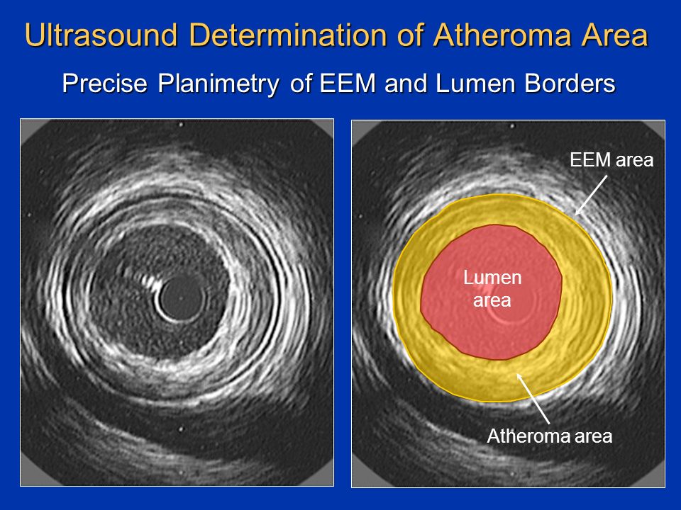 Ultrasound Determination of Atheroma Area Precise Planimetry of EEM and Lumen Borders Atheroma area Lumen area EEM area