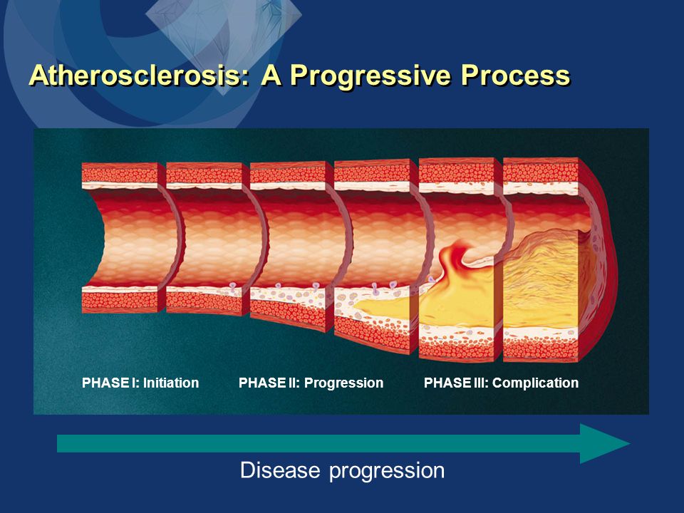 Atherosclerosis: A Progressive Process Disease progression PHASE I: Initiation PHASE II: ProgressionPHASE III: Complication