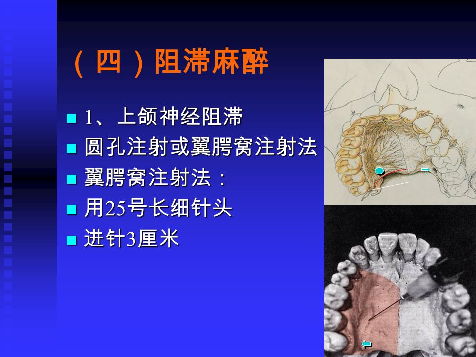 上颌神经阻滞麻醉阻滞麻醉进针点阻滞麻醉鼻腭神经阻滞麻醉腭大孔阻滞