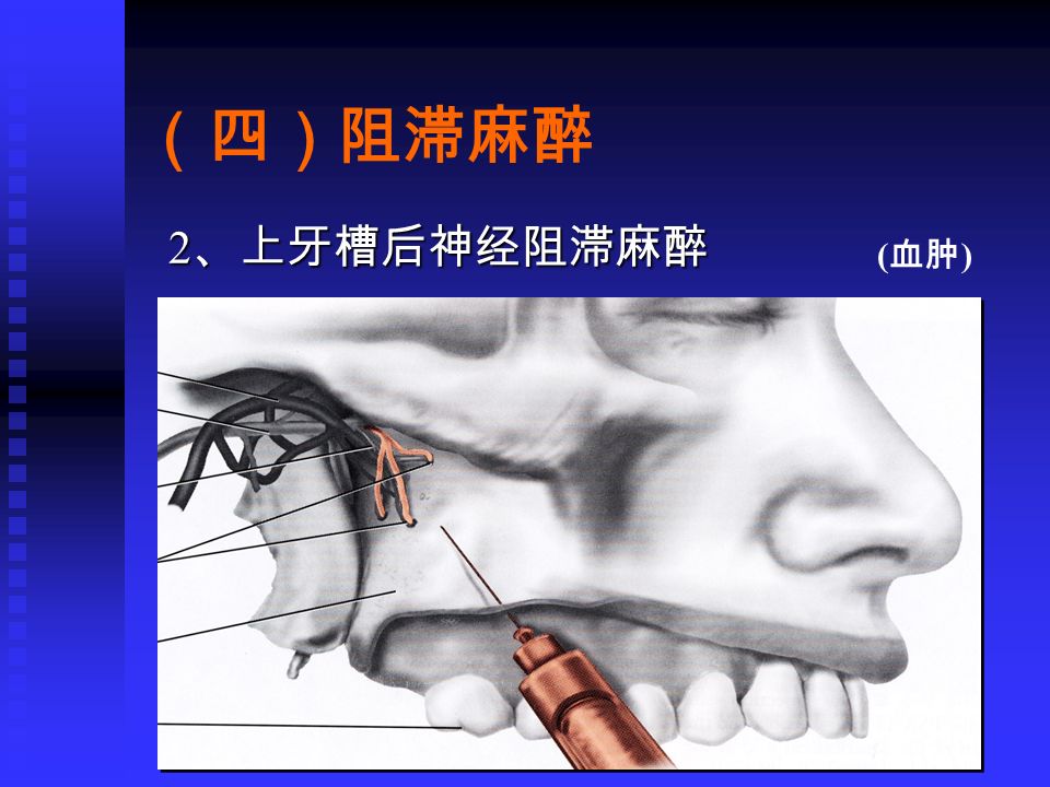 上颌神经阻滞麻醉下牙槽阻滞麻醉进针图上颌阻滞麻醉进针点图上颌结节