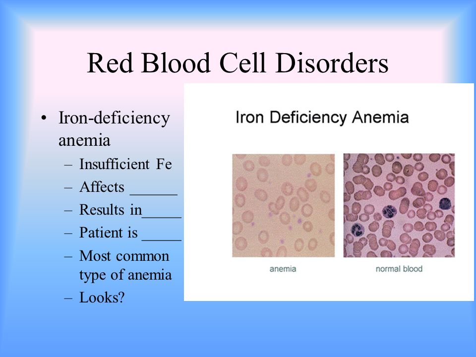Red Blood Cell Disorders Iron-deficiency anemia –Insufficient Fe –Affects ______ –Results in_____ –Patient is _____ –Most common type of anemia –Looks