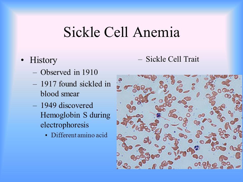Sickle Cell Anemia History –Observed in 1910 –1917 found sickled in blood smear –1949 discovered Hemoglobin S during electrophoresis Different amino acid –Sickle Cell Trait