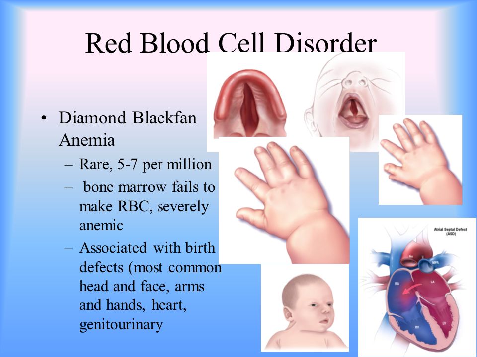 Red Blood Cell Disorder Diamond Blackfan Anemia –Rare, 5-7 per million – bone marrow fails to make RBC, severely anemic –Associated with birth defects (most common head and face, arms and hands, heart, genitourinary