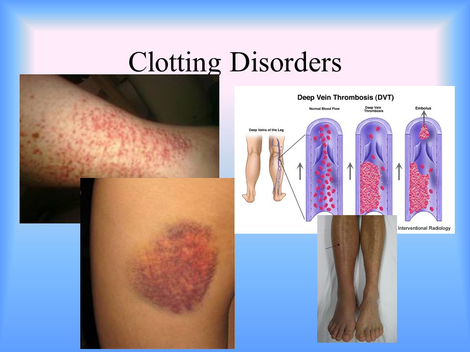 Clotting Disorders