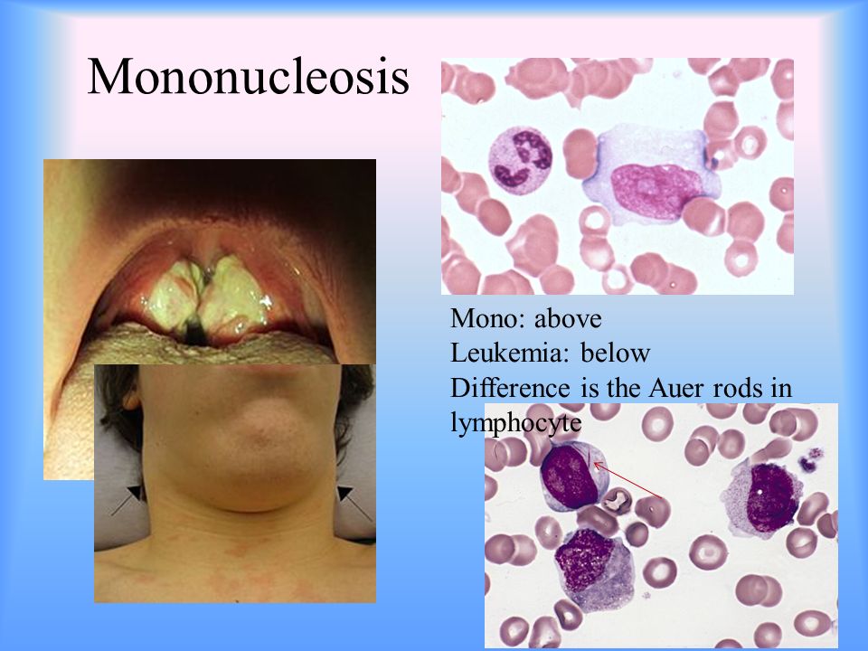 Mononucleosis Mono: above Leukemia: below Difference is the Auer rods in lymphocyte