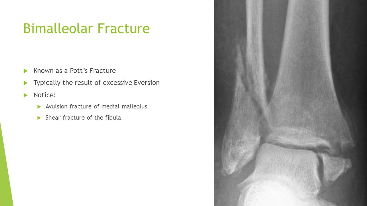 pott s fracture