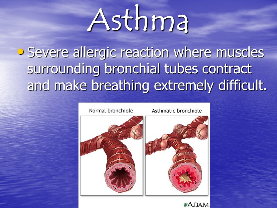 Asthma Severe allergic reaction where muscles surrounding bronchial tubes contract and make breathing extremely difficult.