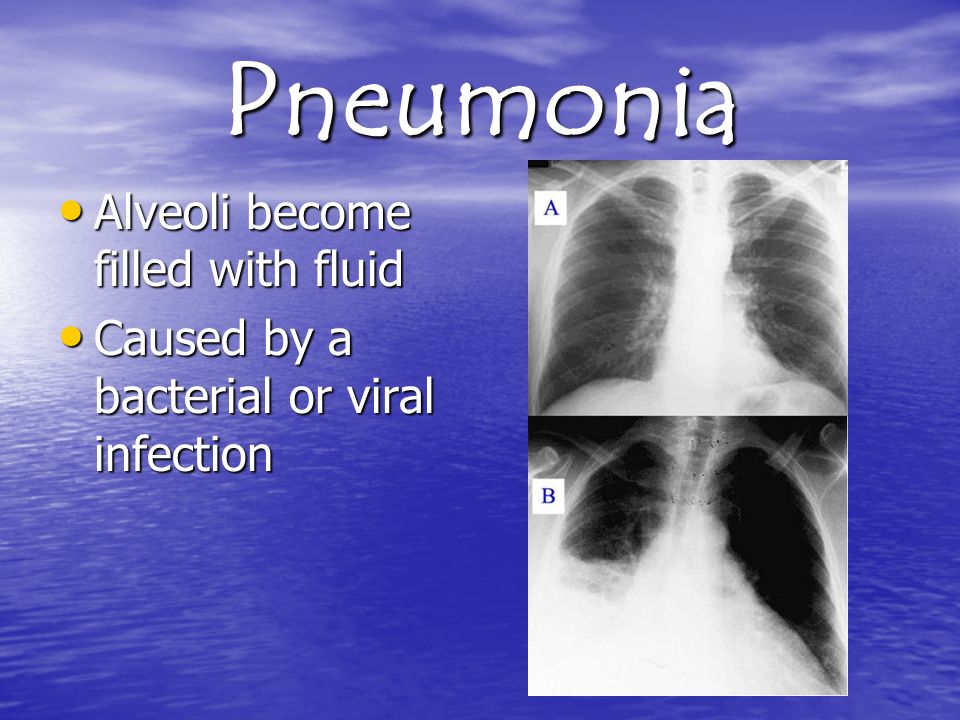 Pneumonia Alveoli become filled with fluid Alveoli become filled with fluid Caused by a bacterial or viral infection Caused by a bacterial or viral infection