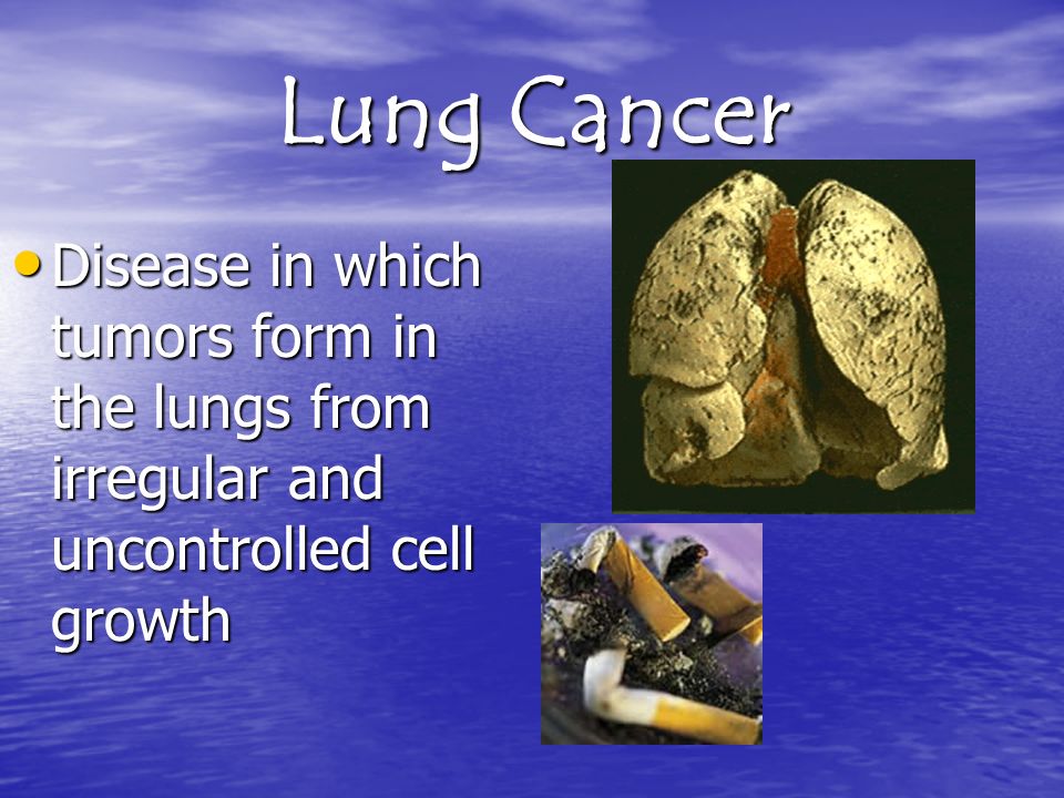Lung Cancer Disease in which tumors form in the lungs from irregular and uncontrolled cell growth Disease in which tumors form in the lungs from irregular and uncontrolled cell growth