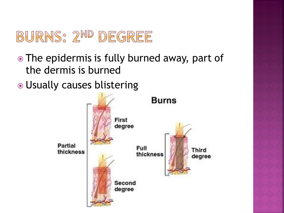  The epidermis is fully burned away, part of the dermis is burned  Usually causes blistering