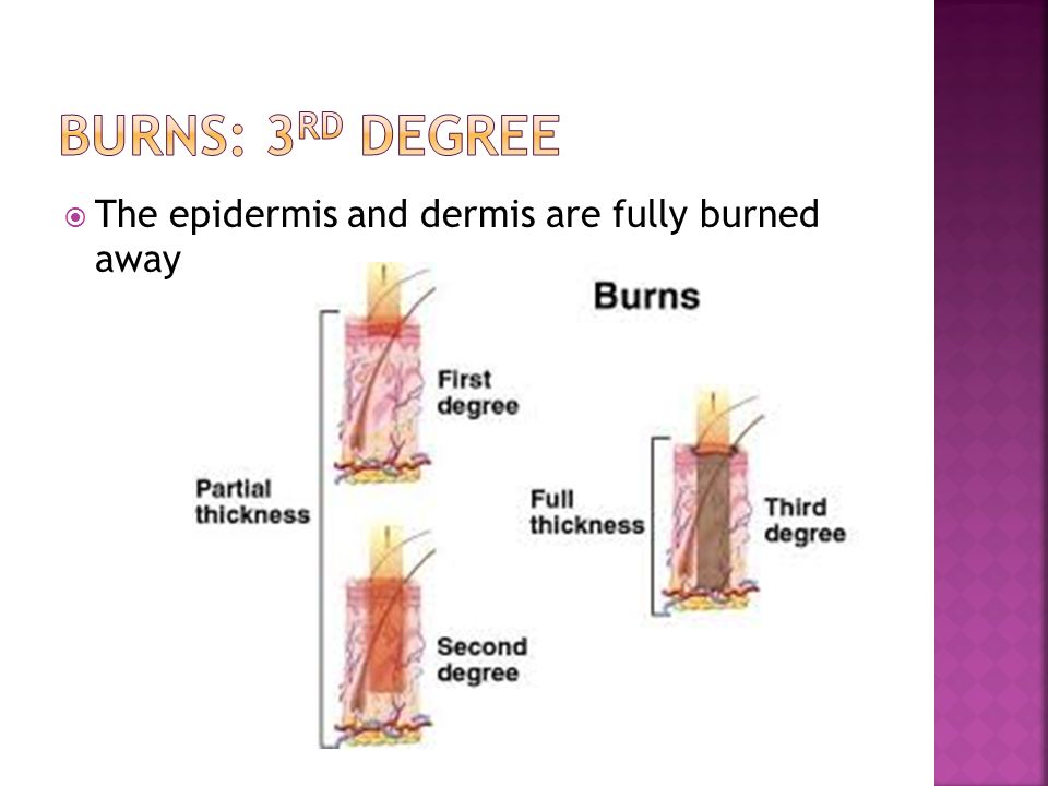  The epidermis and dermis are fully burned away