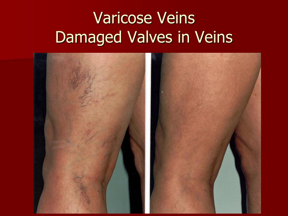 Varicose Veins Damaged Valves in Veins