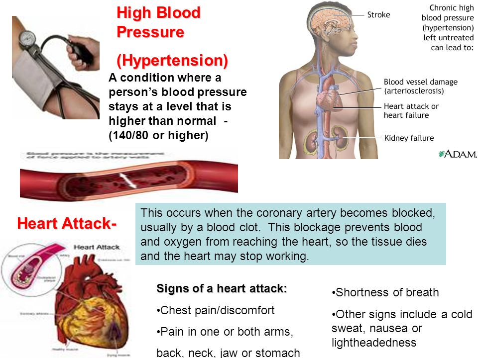 High Blood Pressure (Hypertension) A condition where a person’s blood pressure stays at a level that is higher than normal - (140/80 or higher) Heart Attack- This occurs when the coronary artery becomes blocked, usually by a blood clot.