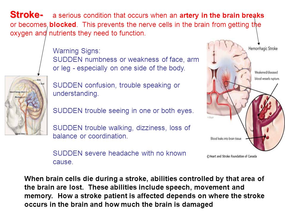 Stroke- Stroke- a serious condition that occurs when an artery in the brain breaks or becomes blocked.