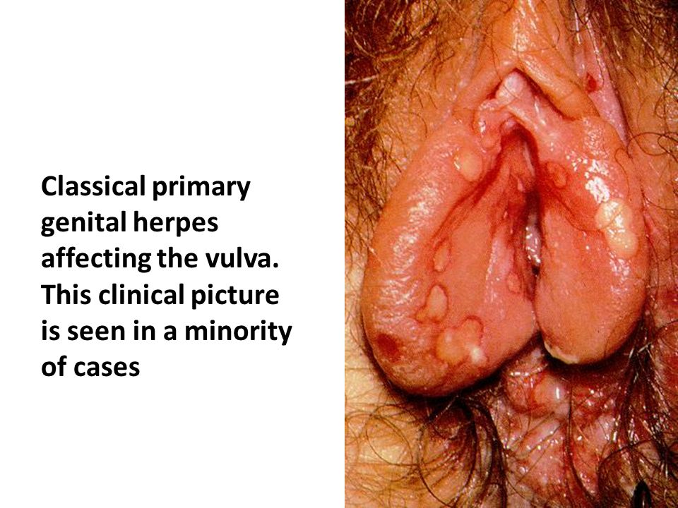 Genital herpes on vaginal area
